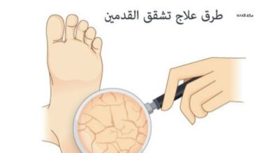 علاج تشققات القدمين